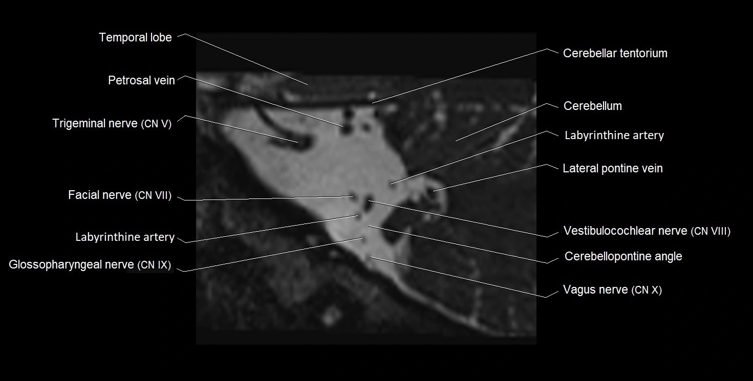 Internal auditory meatus (IAM) 3T sagittal cross sectional anatomy image 34.webp